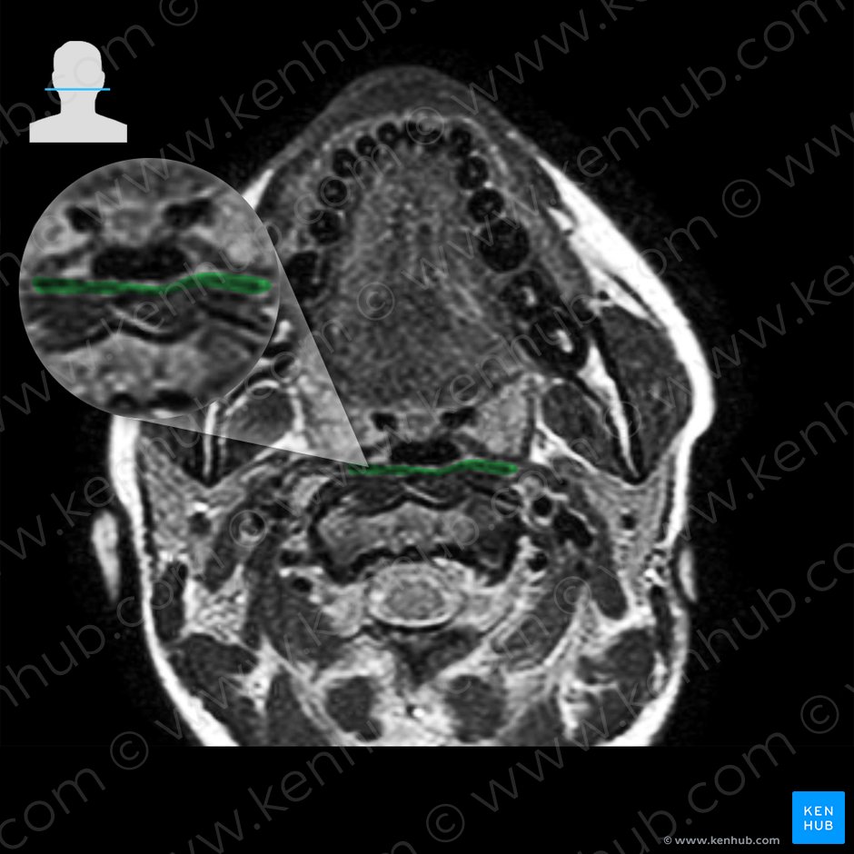 Músculo constritor médio da faringe (Musculus constrictor medius pharyngis); Imagem: 