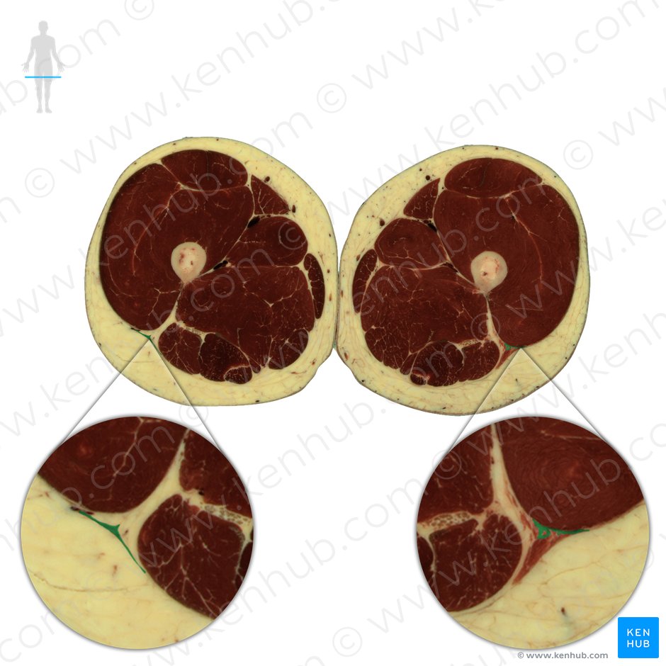 Iliotibial tract (Tractus iliotibialis); Image: National Library of Medicine